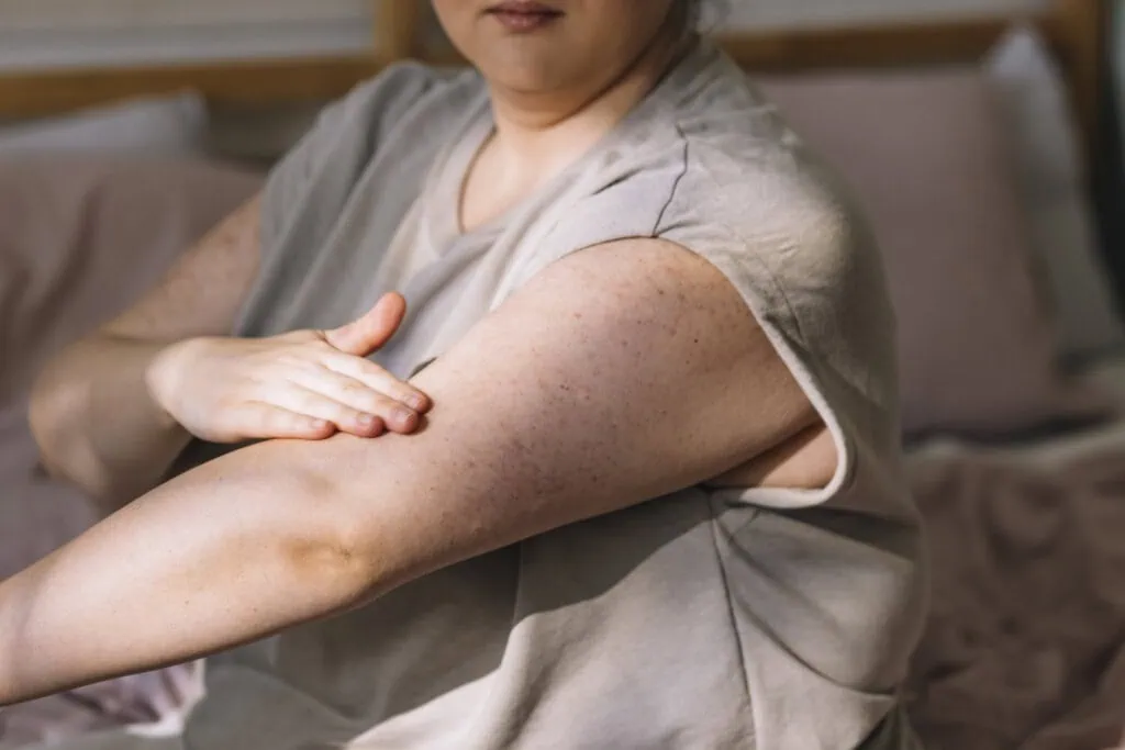 Eine Frau untersucht ihren Arm auf Auffälligkeiten - sie weiß, was ein Lipödem ist und worauf sie achten muss
